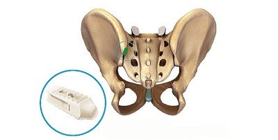 Minimally Invasive Sacroiliac Joint Fusion Provides Fast Recovery